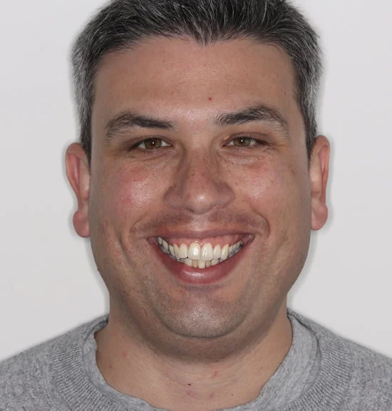 Patient one before Invisalign treatment, full face
