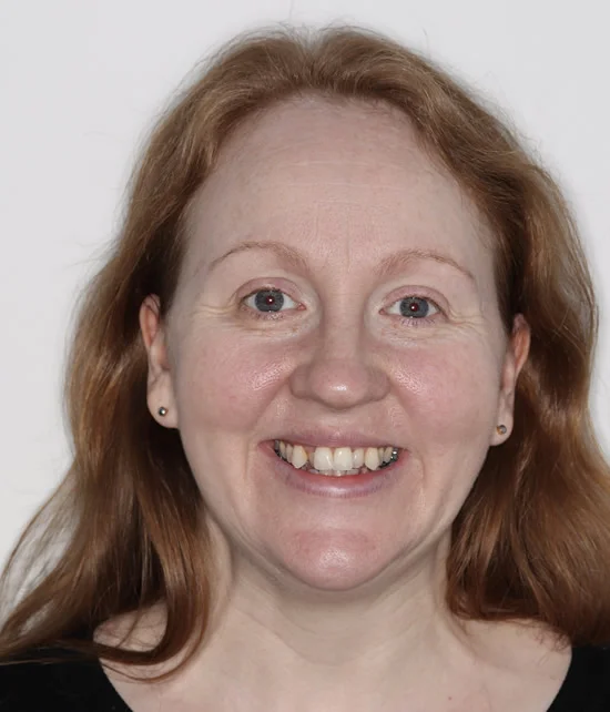 Patient three before Invisalign treatment, full face