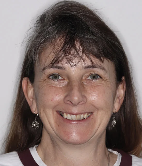 Patient four before Invisalign treatment, full face