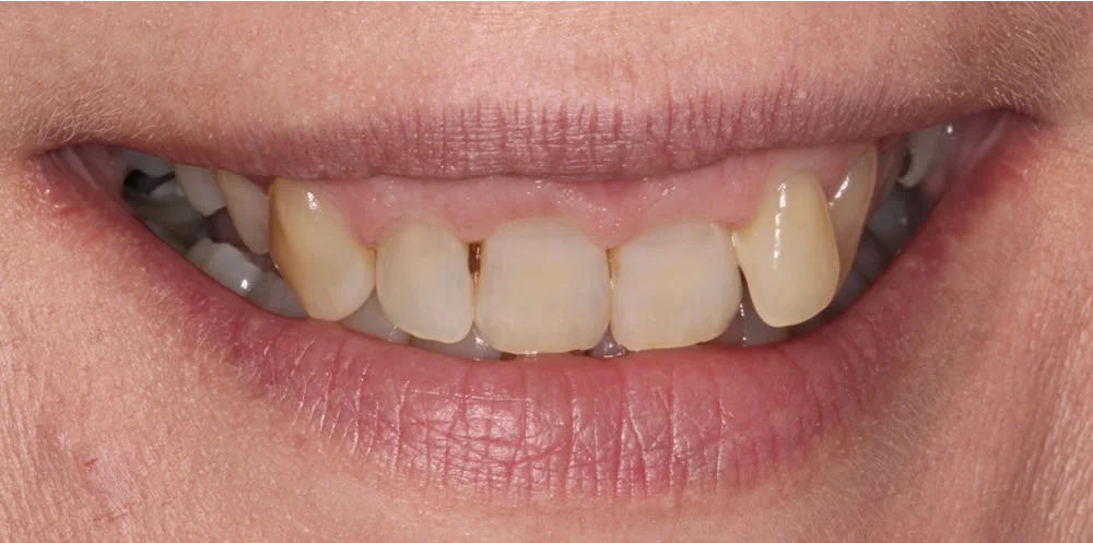 Patient five before Invisalign treatment, smile close up