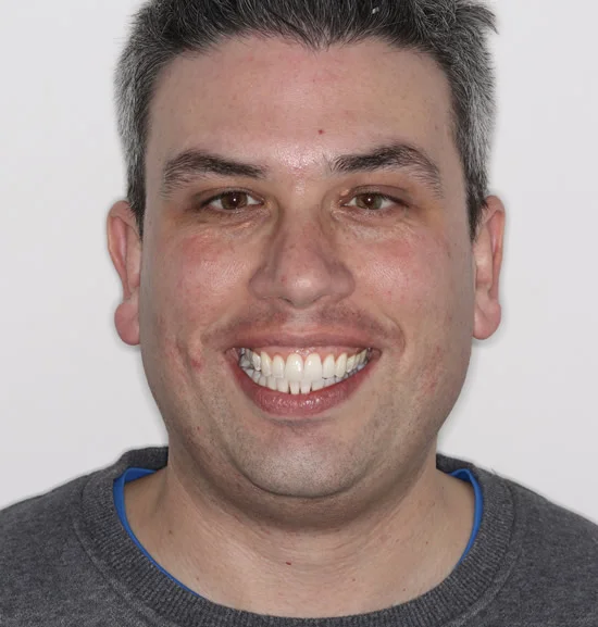 Patient one after Invisalign treatment, full face
