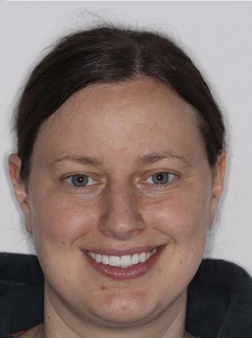 Patient two after Invisalign treatment, full face
