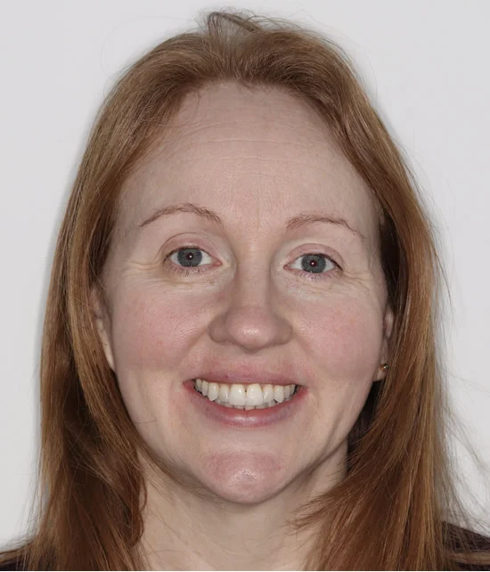 Patient three after Invisalign treatment, full face