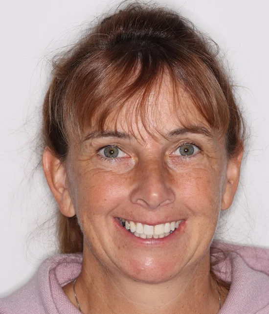 Patient four after Invisalign treatment, full face