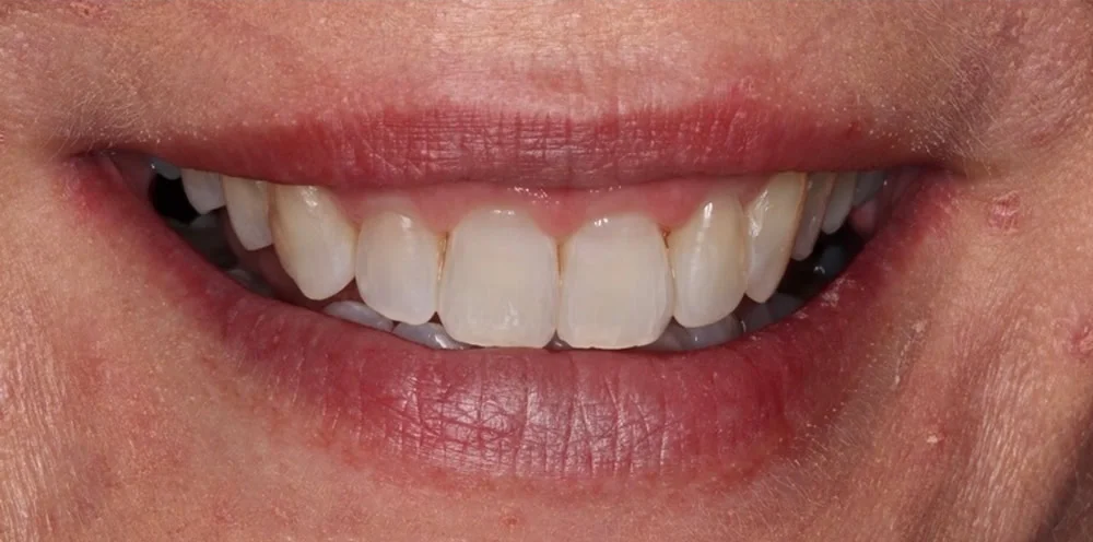 Patient five after Invisalign treatment, smile close up