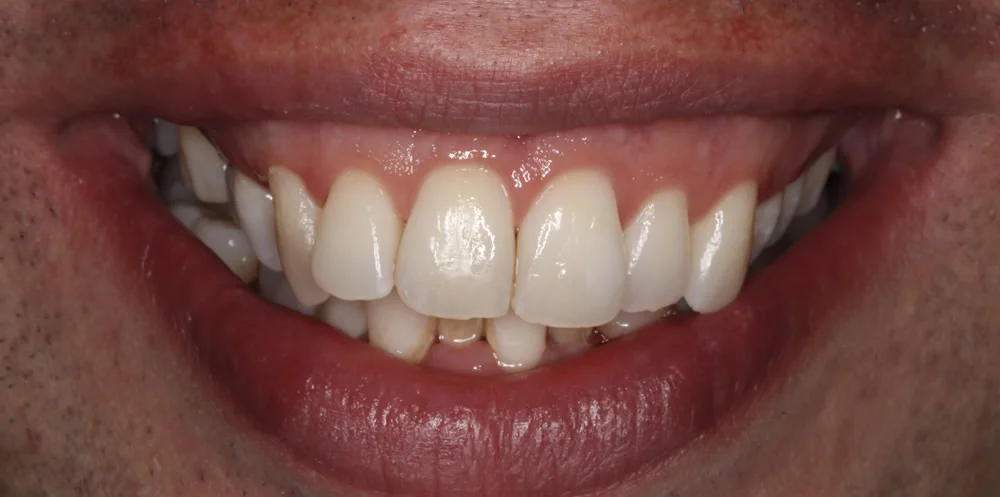 Patient one before Invisalign treatment, smile seen from the front