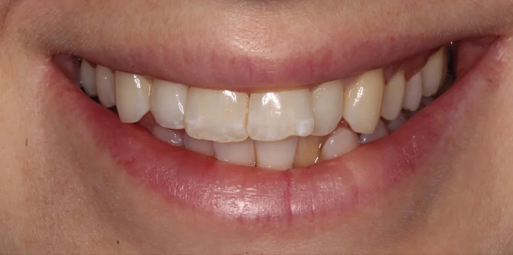 Patient two before Invisalign treatment, smile close up