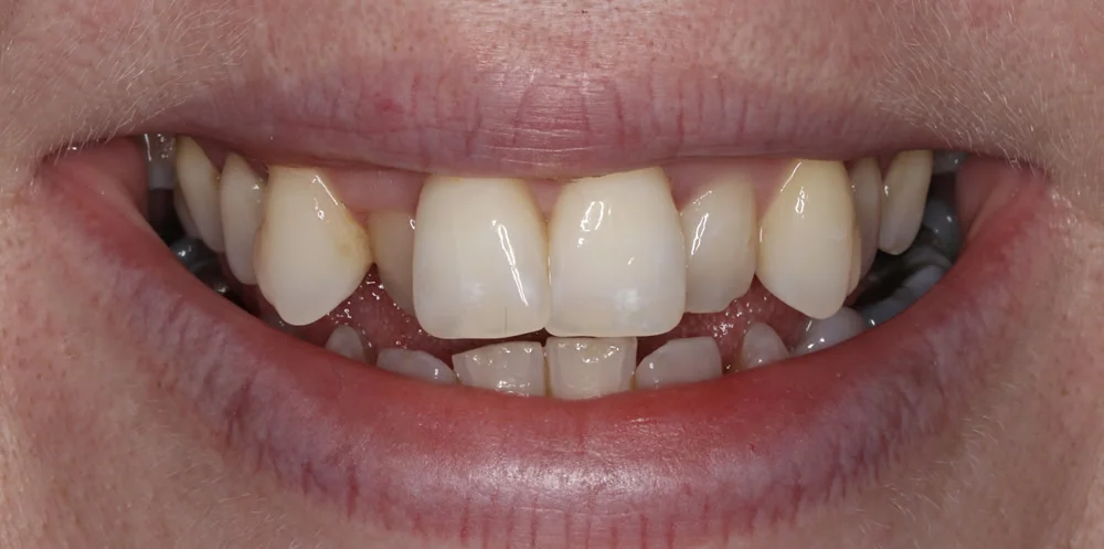 Patient three before Invisalign treatment, smile close up