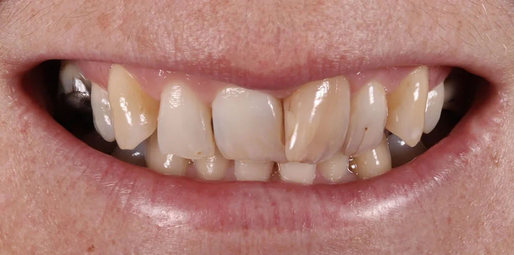 Patient four before Invisalign treatment, smile close up