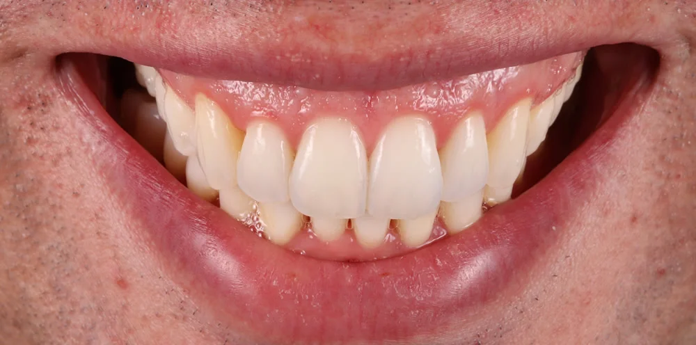 Patient one after Invisalign treatment, smile seen from the front