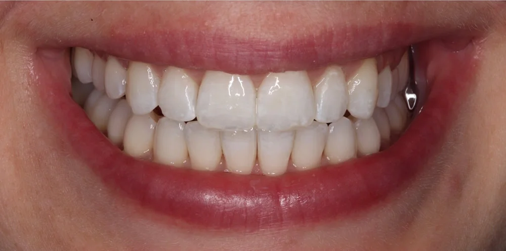 Patient two after Invisalign treatment, smile close up