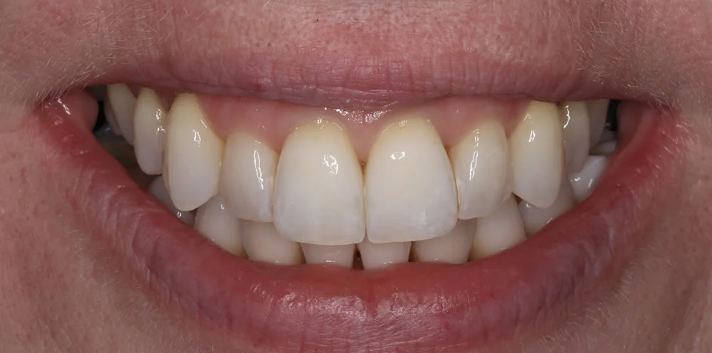 Patient three after Invisalign treatment, smile close up