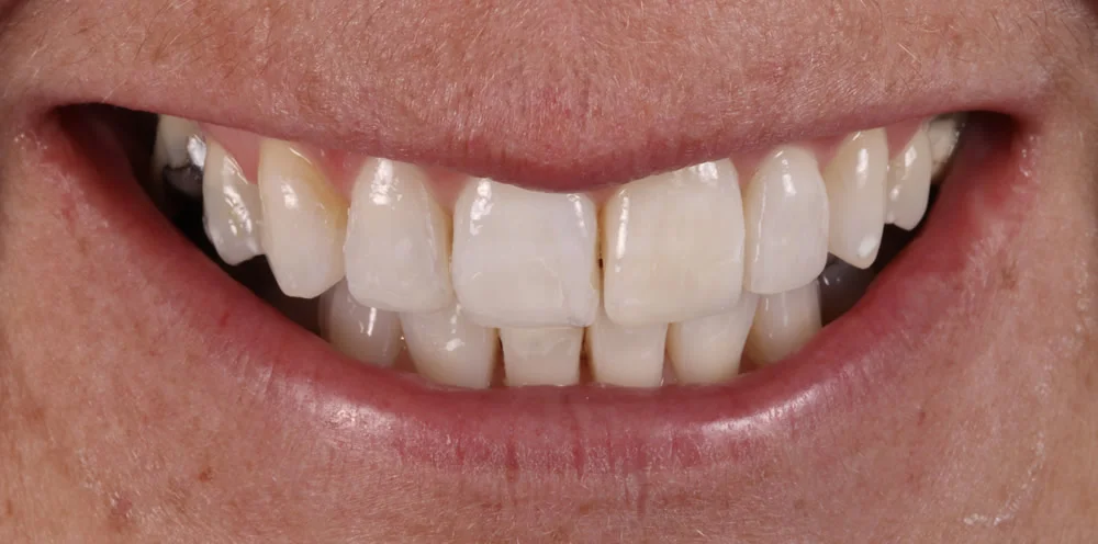 Patient four after Invisalign treatment, smile close up