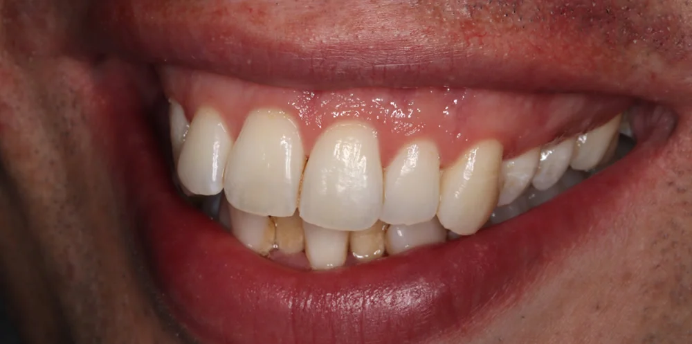 Patient one before Invisalign treatment, smile seen from an angle