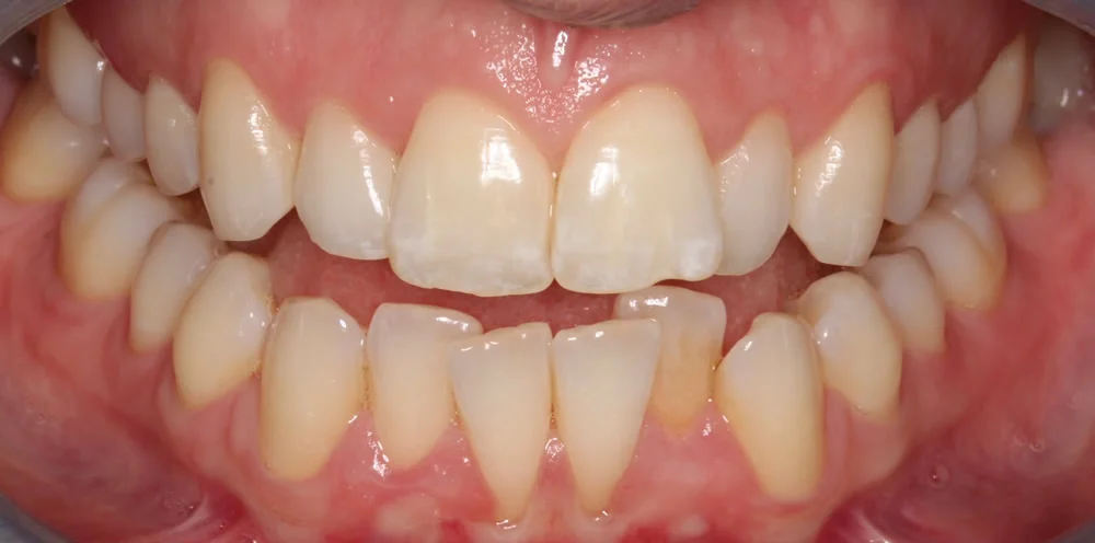 Patient two before Invisalign treatment, front view of the teeth