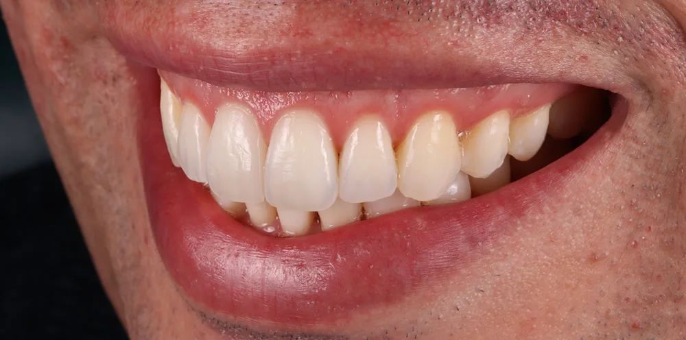 Patient one after Invisalign treatment, smile seen from an angle