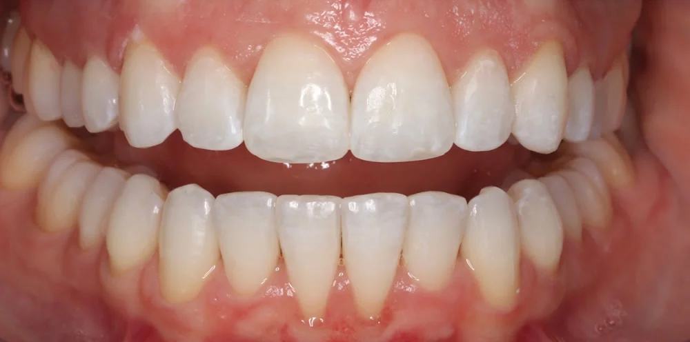 Patient two after Invisalign treatment, front view of the teeth